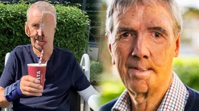 بعد حادث مروع.. بريطاني يستعيد ملامحه بوجه مطبوع بتقنية ثلاثية الأبعاد