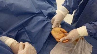 لأول مرة.. مستشفى المنشأة المركزي يجري عملية دقيقة لتوسيع النفق الرسغي بسوهاج 