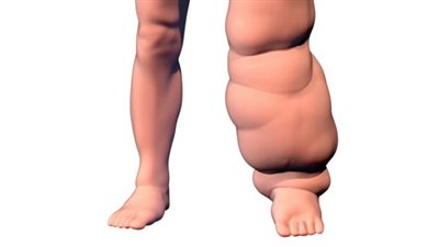 معلومات لا تعرفها عن مرض داء الفيل