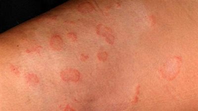 “الثآليل” عدوى تناسلية تصيب الرجل والمرأة وتنتقل الإصابة من الأم لرضيعها