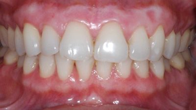 احذر من تراكم البكتريا فقد تسبب آلام الأسنان