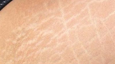 تعرفي على علاج الخطوط البيضاء “الإسترتش مارك” بالجسم