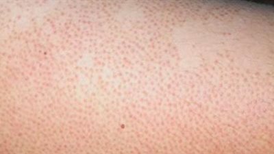 7 طرق للتخلص من جلد الوزة.. تعرف عليها