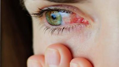 نصائح للوقاية من التهابات العين 