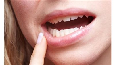 5 نصائح للوقاية من سرطان الفم.. أبرزها الابتعاد عن الشمس