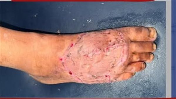 انقاذ قدم مريض