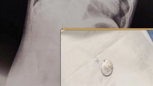 إنقاذ حياة طفل بعد