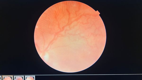 رمد المنصورة تنجح