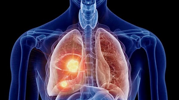 سرطان الرئة - صورة