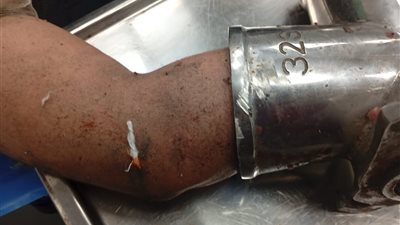 إيده اتهرست جوه المفرمة.. إنقاذ شاب من الموت المحقق في مستشفى العجمي بالإسكندرية