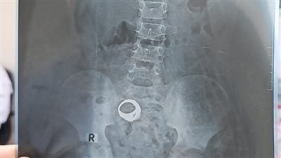 ليست حالة طارئة.. مستشفى كوم حمادة يكشف حقيقة البحث عن صغير لوجود خاتم في بطنه