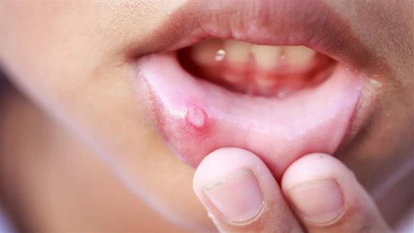 الهربس الفموي