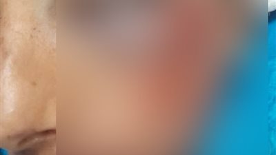 إصابة طالب إعدادي على يد زميله بإحدى مدارس الإسماعيلية.. ونقله إلى الرعاية المركزة