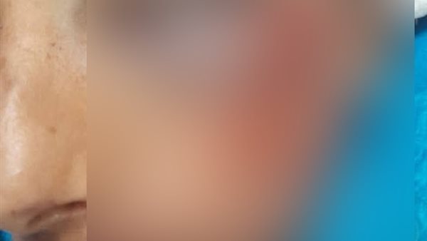 الطالب المصاب