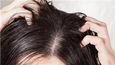 أفضل طرق التخلص من قشرة الرأس والحواجب؟.. تعرف عليها