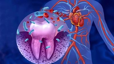 أدلة علمية جديدة تربط مشكلات اللثة بزيادة مخاطر أمراض القلب والشرايين
