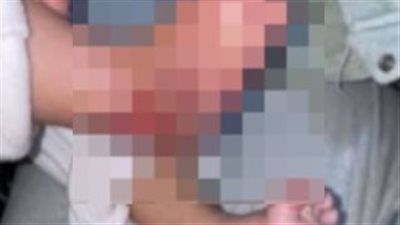 وقعوا مادة كاوية على رجلها.. أسرة طفلة تتهم مركزًا طبيًا بالتسبب في حروق لابنتهم