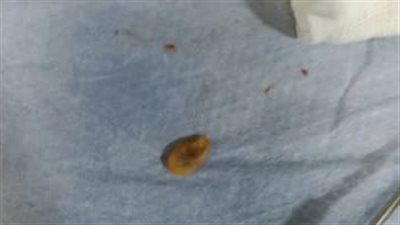 إنقاذ حياة صغير بعد استخراج حبة لب من الشعب الهوائية بمستشفى بنها التخصصي