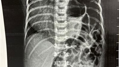 مستشفى الفيوم العام ينجح في إجراء جراحة نادرة لإنقاذ حياة رضيع عمره 9 أيام