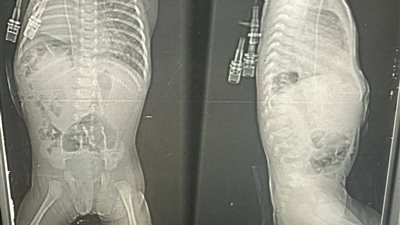 حالة الرضيعة    