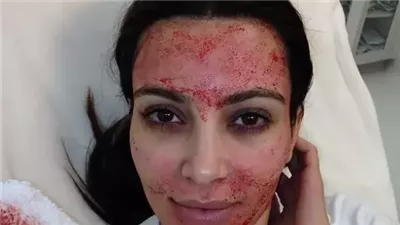 من فضلات الطيور إلى مشيمة الأغنام..علاجات تجميل غريبة تعود إلى الواجهة