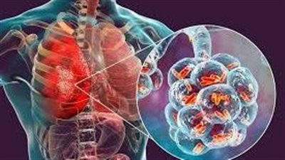  ما هو مرض الفيلق؟.. تعرف على الأسباب والأعراض ومن هو الأكثر عرضة للخطر 