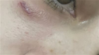 عيني كانت هتروح مني.. سيدة تزعم تعرضها لإهمال طبي داخل عيادة تجميل