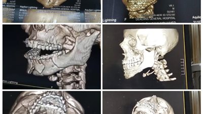 نجاح فريق دكرنس العام في إنقاذ طفل من تهشم كامل بعظام الوجه والفكين