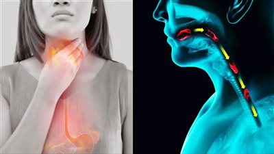 أسباب الإصابة بالارتجاع الحنجري