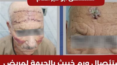مستشفى أبو قير العام ينجح في إزالة ورم بجبهة مسن في الإسكندرية 