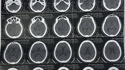 مستشفى السنبلاوين العام بالدقهلية ينجح في إنقاذ حالتين من السكتة الدماغية