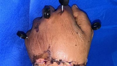 نجاح جراحة دقيقة لزراعة يد مبتورة بمستشفى جامعة الزقازيق