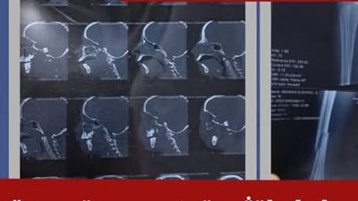 بمشاركة 5 أطباء.. مستشفى العامرية العام بالإسكندرية ينجح في إنقاذ حياة مريض يعاني من كسور متفرقة