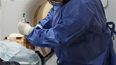 لأول مرة.. استخدام تقنية الأشعة التداخلية بمستشفى صدر دمنهور لسحب عينة من رئة مريض