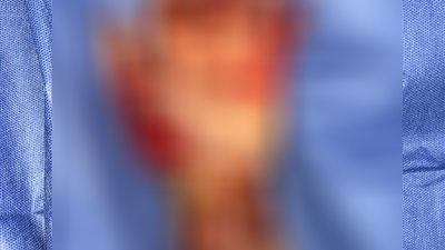 فريق طبي بمستشفى الطوارئ الجديد بجامعة سوهاج ينقذ ذراع طفل بعد إصابة مروعة بطاحونة قمح