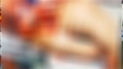 أول تعليق من فتاة قطعت يديها خلال العمل على ماكينة جبن بسوبر ماركت بأكتوبر: إدارة المكان مسألتش فيا.. وعايزة حقي| خاص