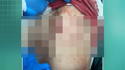 إنقاذ شاب من الموت بعد طعنة نافذة بالقلب في مستشفى المنصورة الدولي