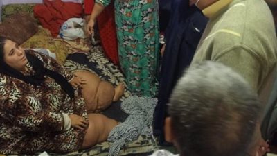 بعد التكليف الرئاسي.. صحة المنوفية تستدعي 6 استشاريين لمناظرة حالة مريضة داء الفيل