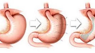 أخصائية تغذية علاجية توضح مفهوم عملية تكميم المعدة (فيديو)
