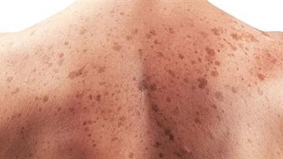 تعرف على أنواع وعلامات سرطان الجلد 