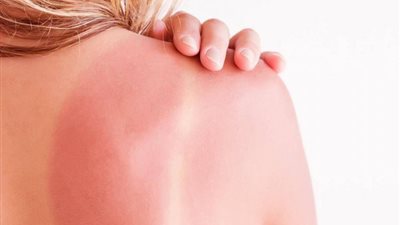 نصائح هامة لعلاج حروق الشمس 