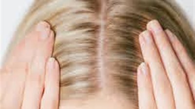 طرق طبيعية لعلاج فطريات فروة الرأس