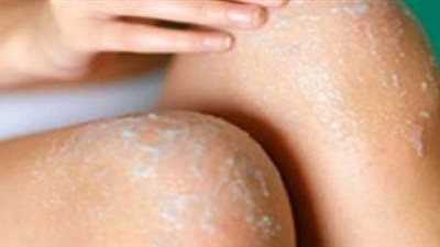 أسباب اسمرار منطقة الركبة وكيفية علاجه طبيعيًا