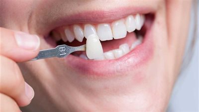 استشاري تجميل يوضح أسباب كسر تركيبات الأسنان (فيديو)