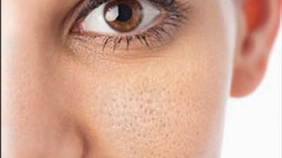 طرق صحية وطبيعية للتخلص من المسام الواسعة
