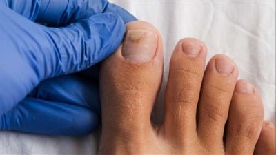 حيلة منزلية سحرية تساعدك على التخلص من فطريات القدم خلال أيام