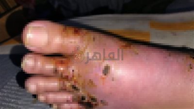 طبيبة بيطرية تناشد التدخل لعلاجها بعد تدهور حالة قدمها: محتاجة حد يتكفل بعلاجي