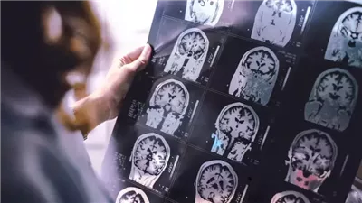 دراسة تحذر: أول نوبة صرع لدى البالغين قد تنذر بالإصابة بورم في الدماغ