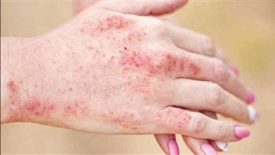 أبرزها تساقط الشعر والتعب.. علامات الإصابة بمرض الذئبة الحمراء 