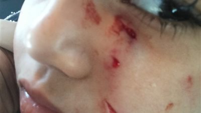 كلب ضال يهاجم صغيرة ويشوّه وجهها في حدائق الأهرام.. ووالدتها تستغيث من عدم قدرتها على العلاج